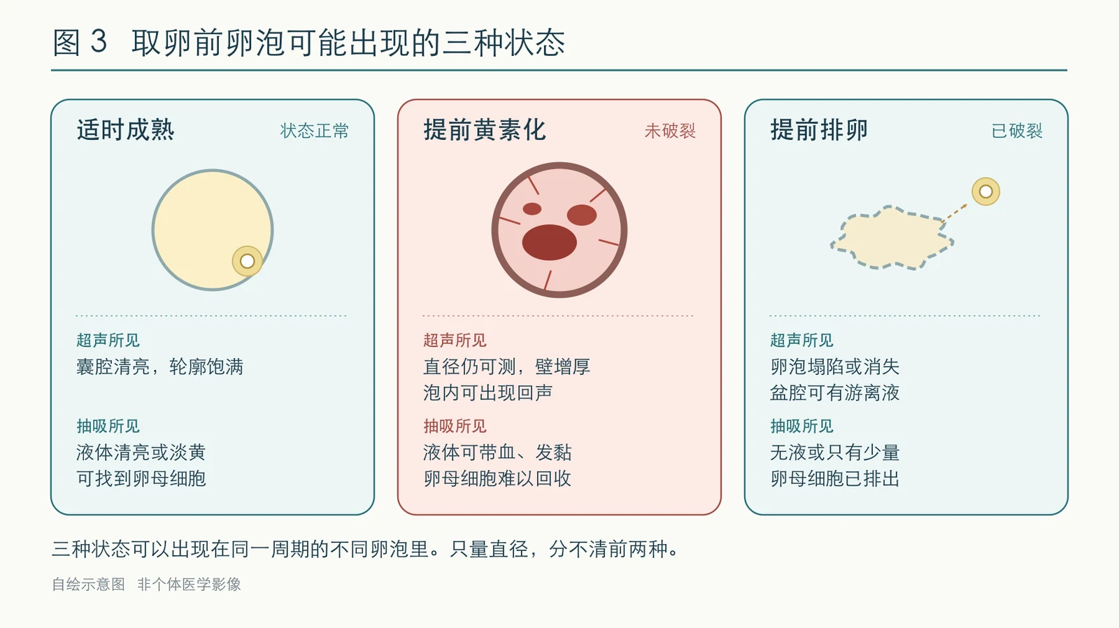 取卵前卵泡可能出现的三种状态