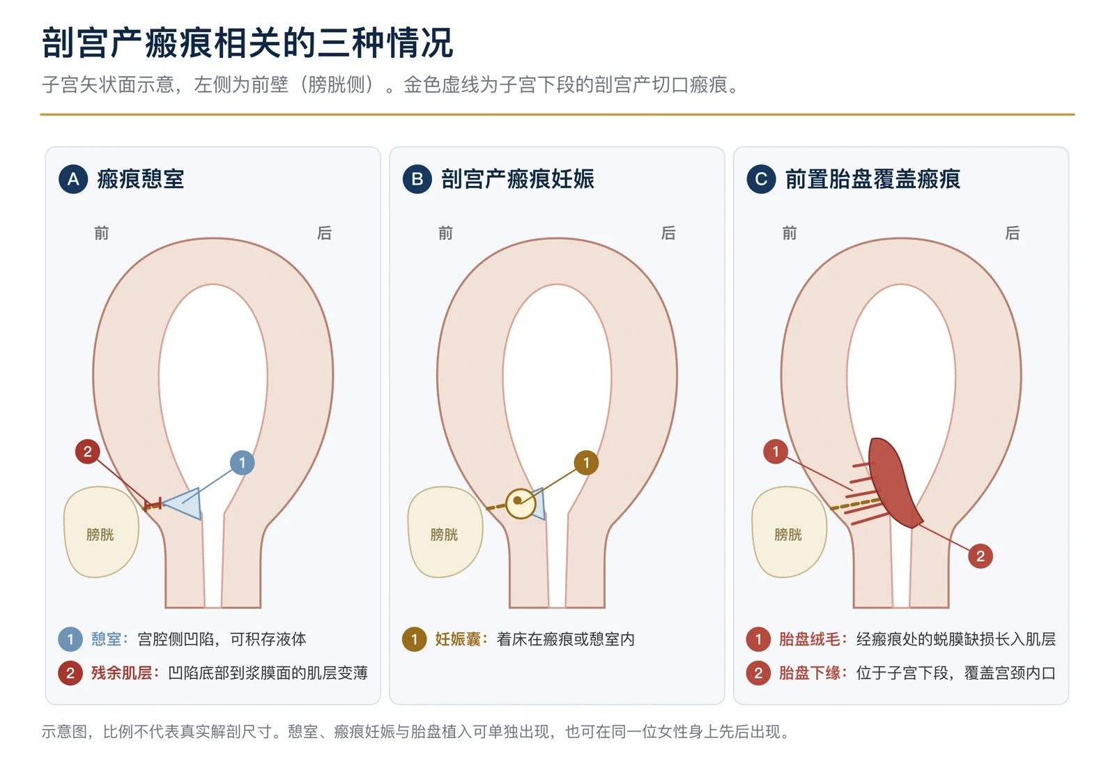 图2 瘢痕憩室、瘢痕妊娠与胎盘植入的结构示意