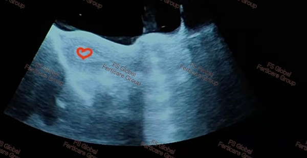 The ultrasound image retained from this checkup.