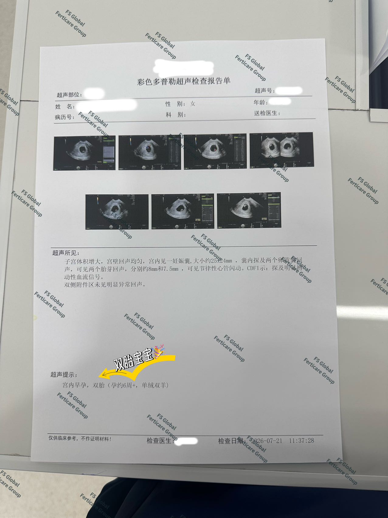 早孕超声检查与宫内双胎确认资料。 4/4