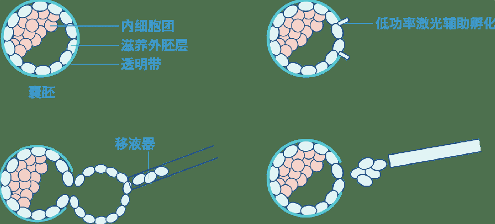囊胚期活检时机对PGT检测质量与妊娠结局的影响